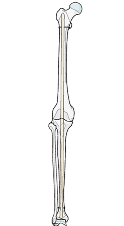 Інтрамедулярний стегново-великогомілковий стрижень для артродезу колінного суглоба (Jinlu)